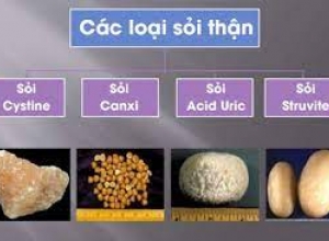 Tổng Quan Bệnh Sỏi Thận - Các Loại Sỏi Thận